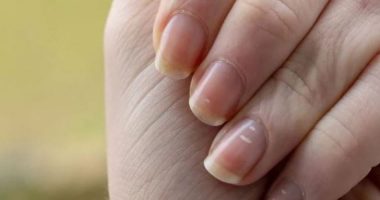 Kjo është arsyeja pse ju shfaqen njollat e bardha tek thonjtë