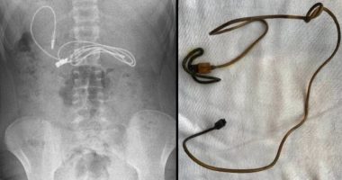 VIDEO/ Adoleshenti shkon me dhimbje të tmerrshme në spital, mjekët vënë duart në kokë kur shohin çfarë kishte në stomak