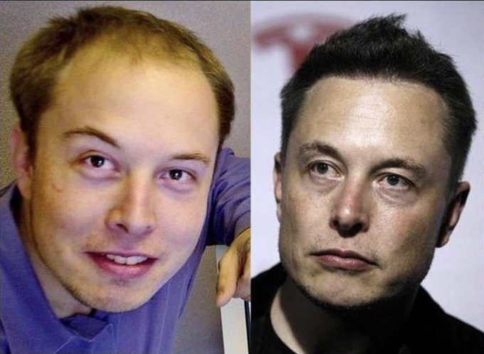 FOTO/ Kirurgu plastik tregon ndërhyrjet që Elon Musk ka bërë në fytyrë, i kushtuan shuma marramendëse