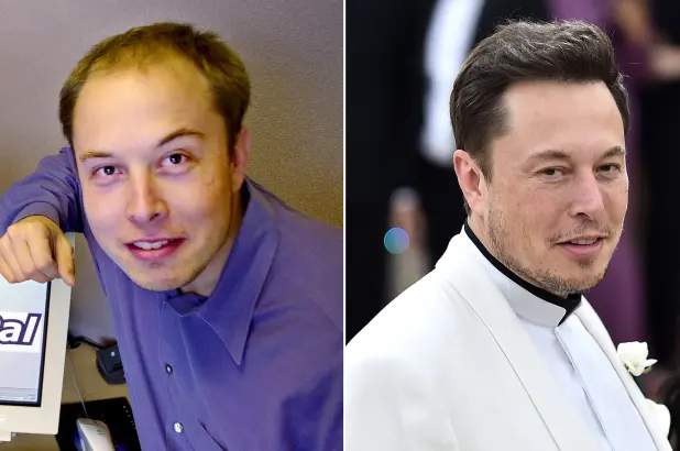 Mijëra dollarë për operacionet plastike, Elon Musk i fiksuar për t’u dukur më i ri