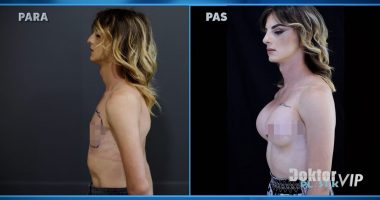 Transgjinorja zmadhon gjoksin në Doktor Plastik