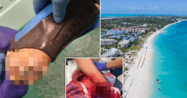 Shkoi për të festuar diplomimin në Karaibe, 22-vjeçarja humb këmbën nga kafshimi i peshkaqenit