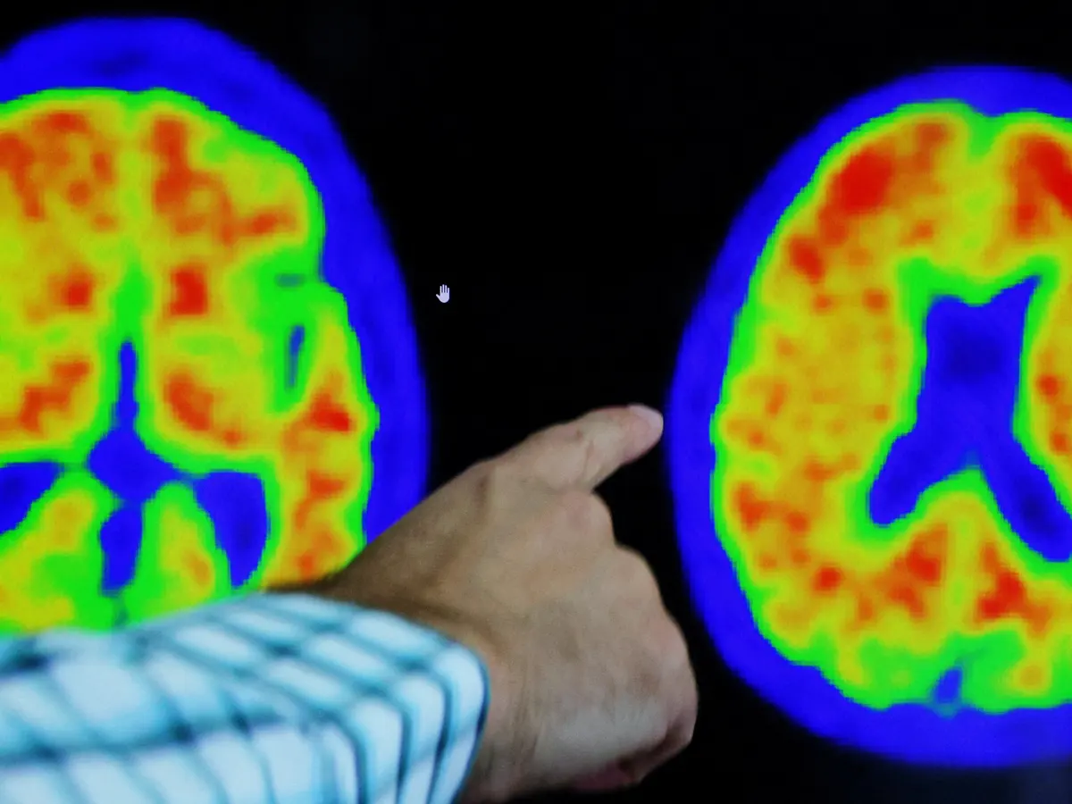 Zbulohet ilaçi për Alzheimerin, ndalon përparimin e sëmundjes