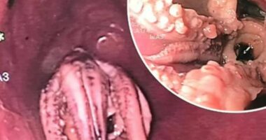 Shtangen mjekët në Korenë e Jugut, gjejnë në fytin e pacientit një oktapod të mbërthyer