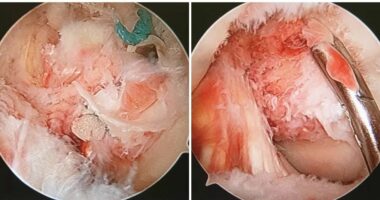 Risi/ Teknologji mjekësore bashkëkohore, profesionalizëm që garanton suksesin e trajtimeve Ortopedike në Spitalin Hygeia