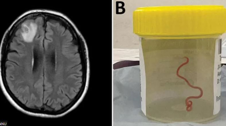 Gjendet krimb i gjallë në trurin e një gruaje, zbulimi i parë në botë që la mjekët pa fjalë