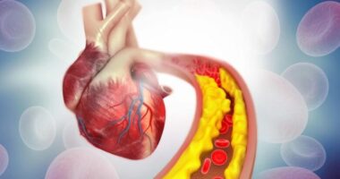 4 ushqimet më të këqija për kolesterolin e lartë