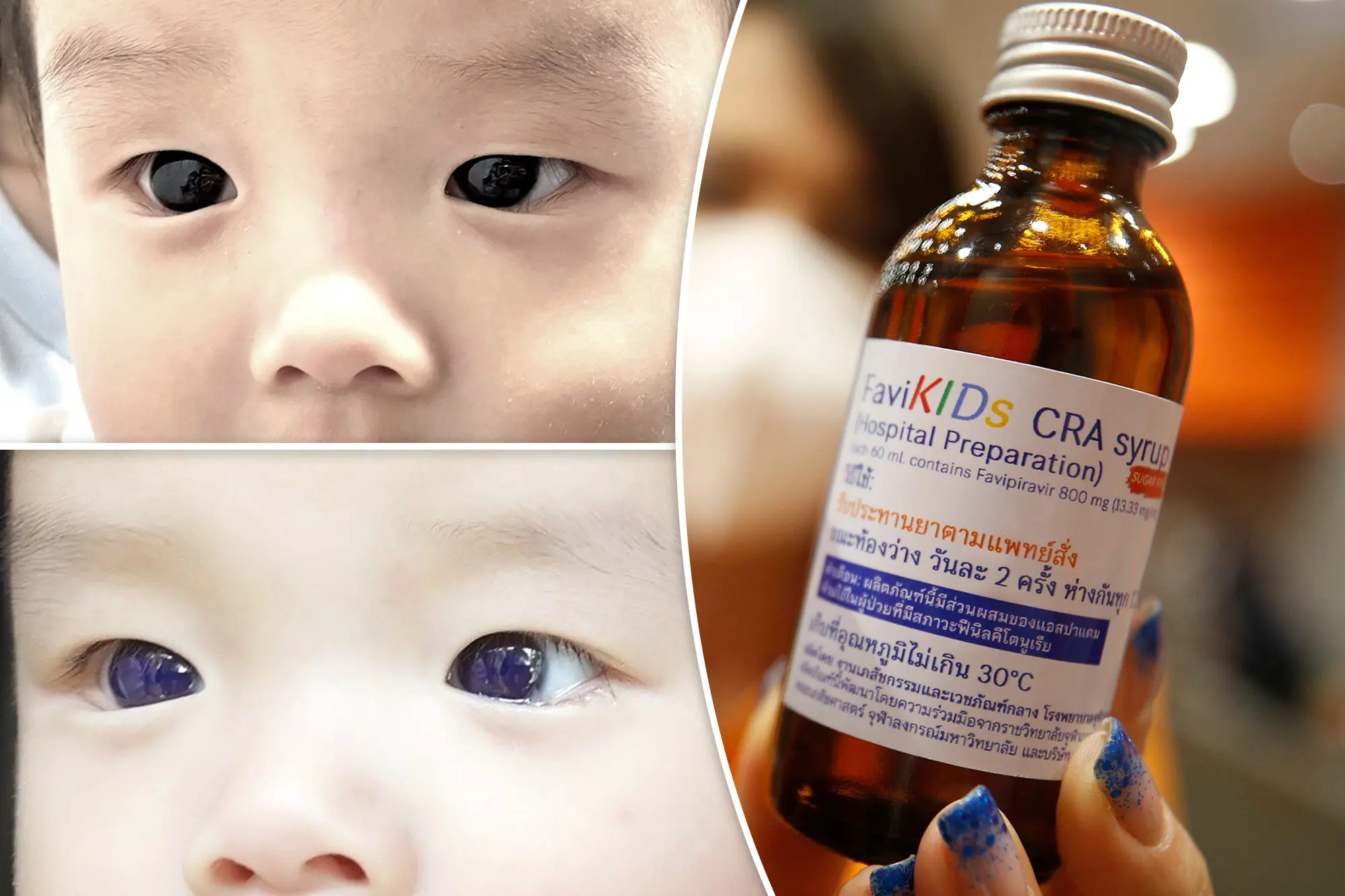 Ilaçi kundër koronavirusit “ndryshoi përkohësisht” ngjyrën e syve të një foshnje