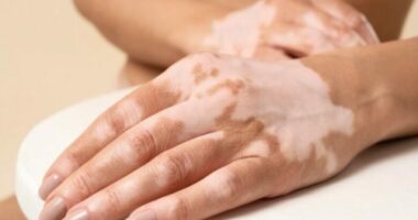 Çfarë është vitligo, shkaqet dhe simptomat