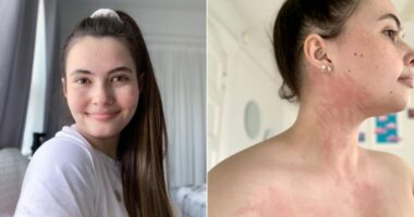 Si jeton 25-vjeçarja që ka alergji nga uji