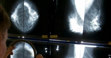 Ekspertët: Mamografia të fillojë në moshën 40 vjeçare