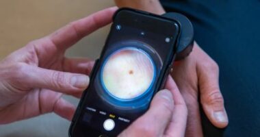 Suedia, vendi i parë në Europë ku normat e kancerit të lëkurës tek të rinjtë po bien