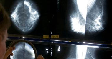 Studimet: Disa paciente me kancer gjiri mund të shmangin operacione të caktuara