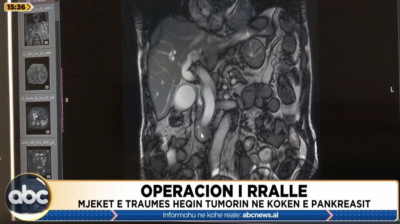 Operacion i rrallë/ Mjekët e Traumës heqin tumorin në kokën e pankreasit