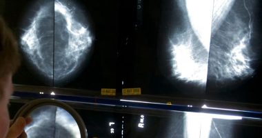 Studimet: Disa paciente me kancer gjiri mund të shmangin operacione të caktuara