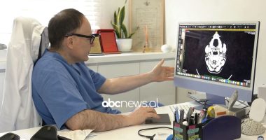 Hiqet tumori përmes…vetullës/ QSUT, kryhet ndërhyrja e rrallë te një 34 vjeçare