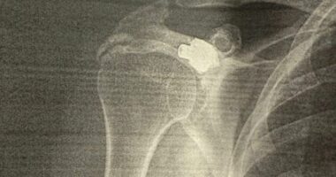 “Plumbi që mbijetoi 27 vjet në trupin tim”/ Rrëfimi i Gramoz Berishës në 18-vjetorin e Pavarësisë