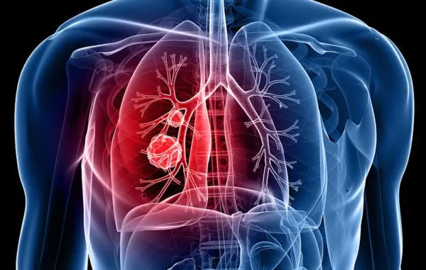 Tuberkulozi, pak të prekur/ ISHP: 240 pacientë në të gjithë vendin