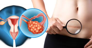 Australi, përgjysmohen rastet e kancerit të mitrës/ Vaksina HPV, arritje historike: Asnjë paciente nën 25 vjeç
