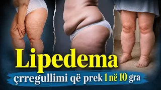 “Qava 3 ditë për diagnozën” Lipedema, sëmundja që prek 1 në 10 gra e shpesh ngatërrohet me mbipeshën